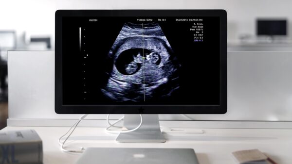 A Woman's Pregnancy Ultrasound Being Watched On A Computer